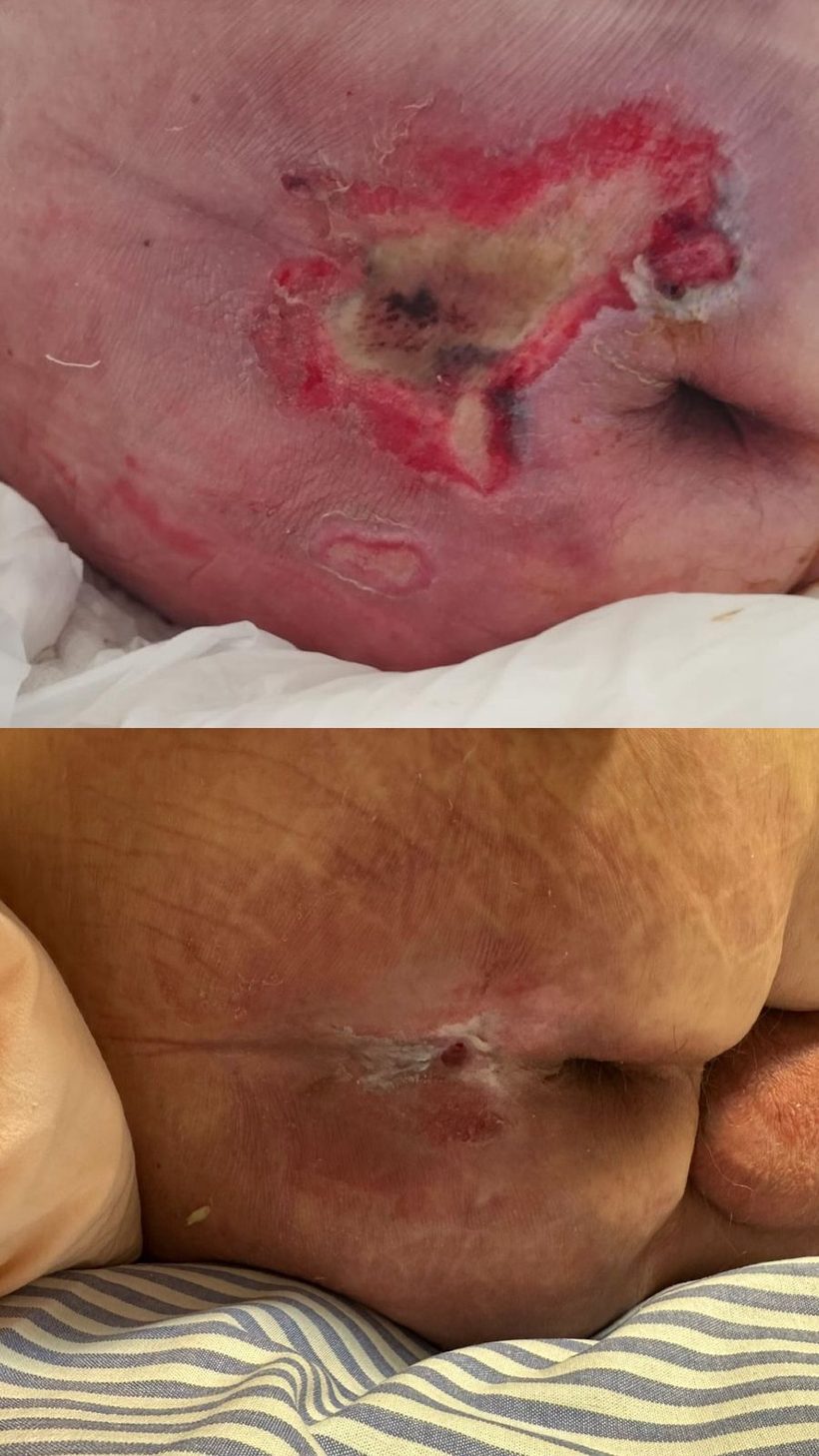 Caso real de cicatrização de ferida acompanhado pela RAC VitalCure — antes e depois