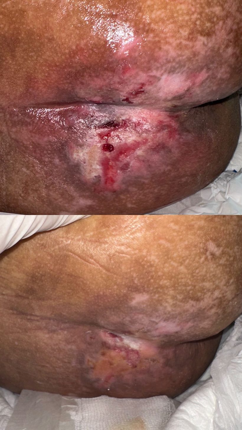 Caso real de cicatrização de ferida acompanhado pela RAC VitalCure — antes e depois