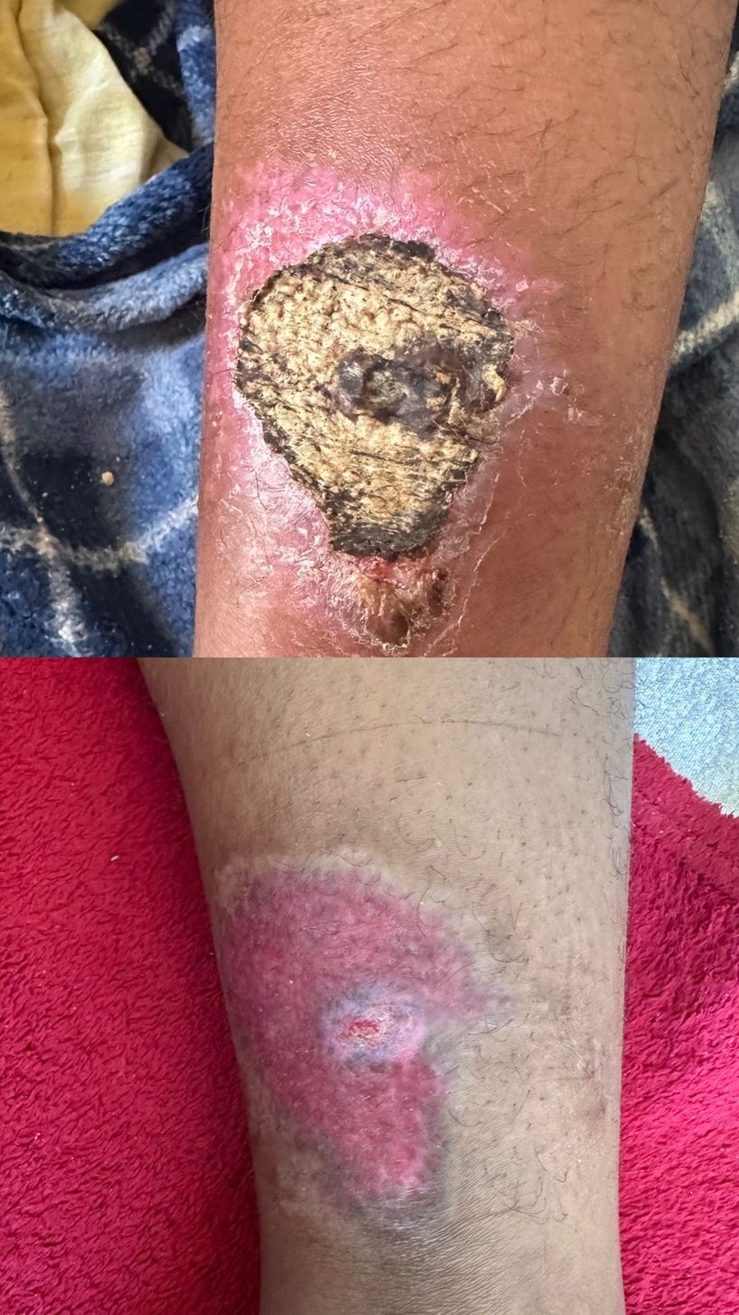 Caso real de cicatrização de ferida acompanhado pela RAC VitalCure — antes e depois
