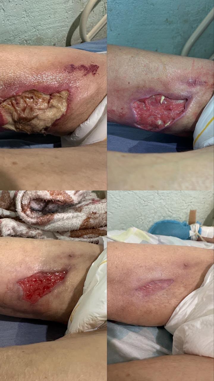 Caso real de cicatrização de ferida acompanhado pela RAC VitalCure — antes e depois